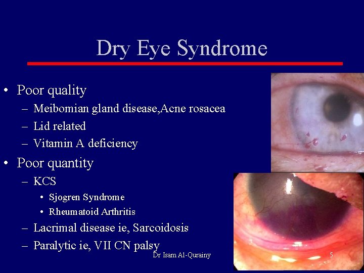 Dry Eye Syndrome • Poor quality – Meibomian gland disease, Acne rosacea – Lid