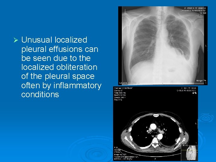 Ø Unusual localized pleural effusions can be seen due to the localized obliteration of