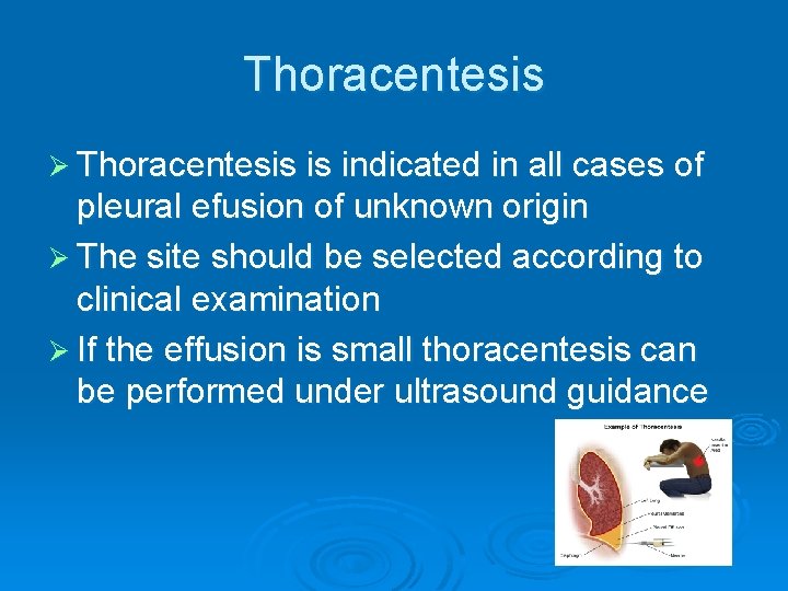 Thoracentesis Ø Thoracentesis is indicated in all cases of pleural efusion of unknown origin