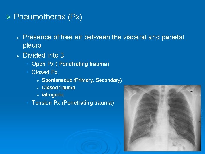 Ø Pneumothorax (Px) l l Presence of free air between the visceral and parietal