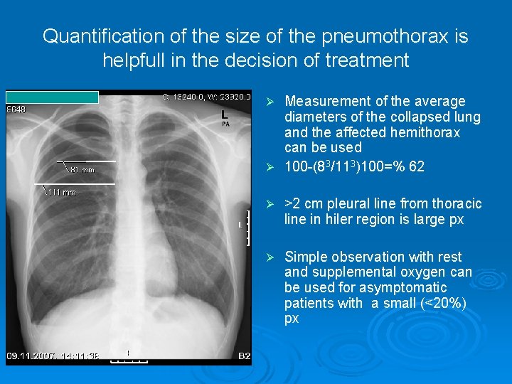 Quantification of the size of the pneumothorax is helpfull in the decision of treatment