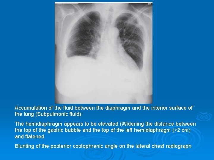 Accumulation of the fluid between the diaphragm and the interior surface of the lung