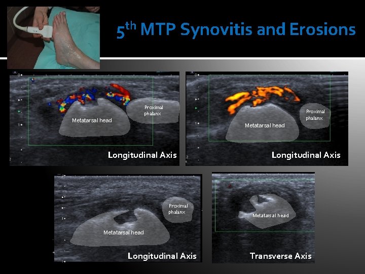 5 th MTP Synovitis and Erosions Proximal phalanx Metatarsal head Longitudinal Axis Proximal phalanx