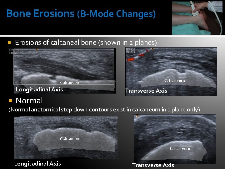 Bone Erosions (B-Mode Changes) Erosions of calcaneal bone (shown in 2 planes) Calcaneum Longitudinal