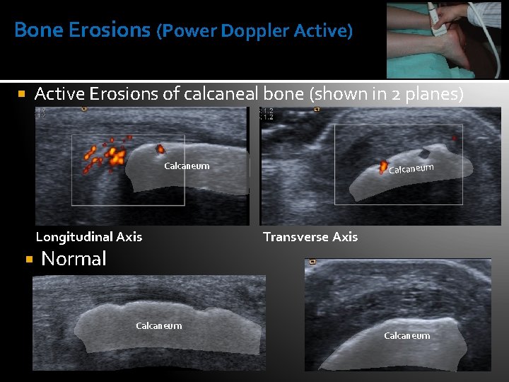 Bone Erosions (Power Doppler Active) Active Erosions of calcaneal bone (shown in 2 planes)
