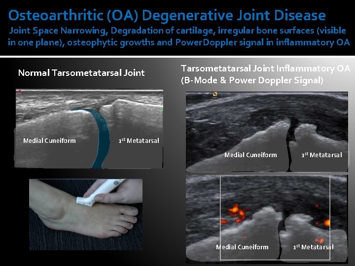 Osteoarthritic (OA) Degenerative Joint Disease Joint Space Narrowing, Degradation of cartilage, irregular bone surfaces