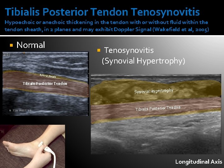 Tibialis Posterior Tendon Tenosynovitis Hypoechoic or anechoic thickening in the tendon with or without