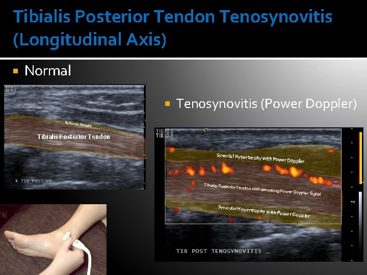 Tibialis Posterior Tendon Tenosynovitis (Longitudinal Axis) Normal Synovial S Tenosynovitis (Power Doppler) heath Tibialis