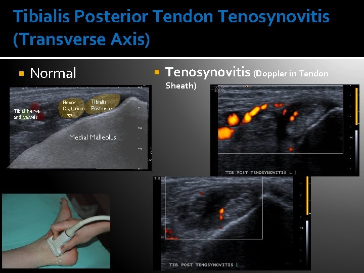 Tibialis Posterior Tendon Tenosynovitis (Transverse Axis) Normal Tibial Nerve and Vessels Flexor Digitorium longus