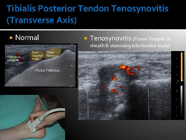 Tibialis Posterior Tendon Tenosynovitis (Transverse Axis) Normal Tenosynovitis (Power Doppler in sheath & stenosing