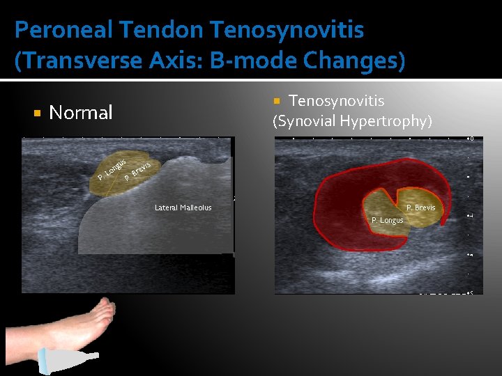 Peroneal Tendon Tenosynovitis (Transverse Axis: B-mode Changes) Tenosynovitis (Synovial Hypertrophy) Normal us P .