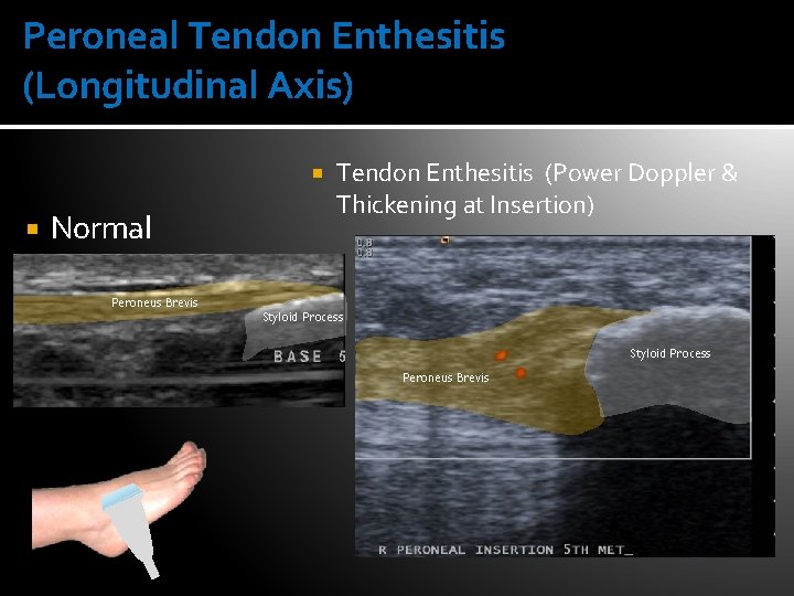 Peroneal Tendon Enthesitis (Longitudinal Axis) Normal Peroneus Brevis Tendon Enthesitis (Power Doppler & Thickening