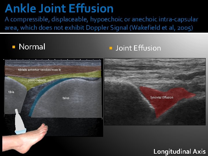 Ankle Joint Effusion A compressible, displaceable, hypoechoic or anechoic intra-capsular area, which does not