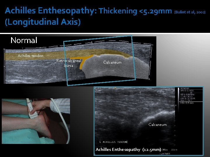 Foot and Ankle Pathology in Rheumatic Diseases Ankle