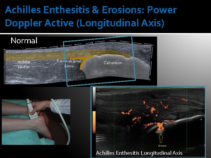 Achilles Enthesitis & Erosions: Power Doppler Active (Longitudinal Axis) Normal Achilles tendon Retrocalcaneal bursa