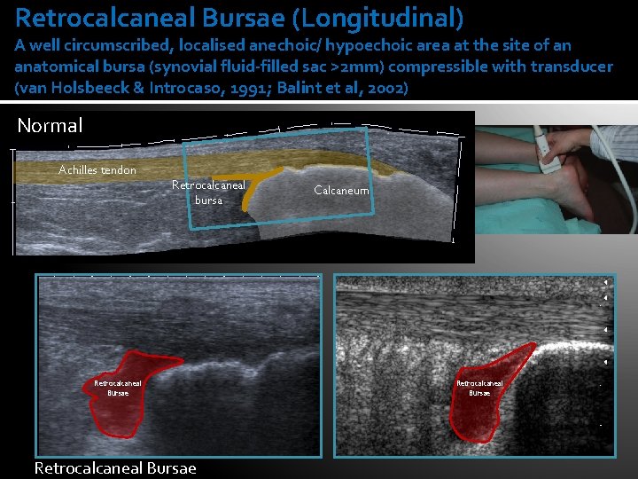 Retrocalcaneal Bursae (Longitudinal) A well circumscribed, localised anechoic/ hypoechoic area at the site of