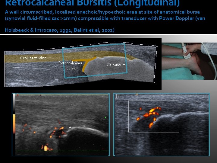 Retrocalcaneal Bursitis (Longitudinal) A well circumscribed, localised anechoic/hypoechoic area at site of anatomical bursa