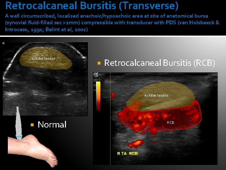 Retrocalcaneal Bursitis (Transverse) A well circumscribed, localised anechoic/hypoechoic area at site of anatomical bursa