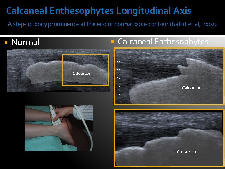 Calcaneal Enthesophytes Longitudinal Axis A step-up bony prominence at the end of normal bone