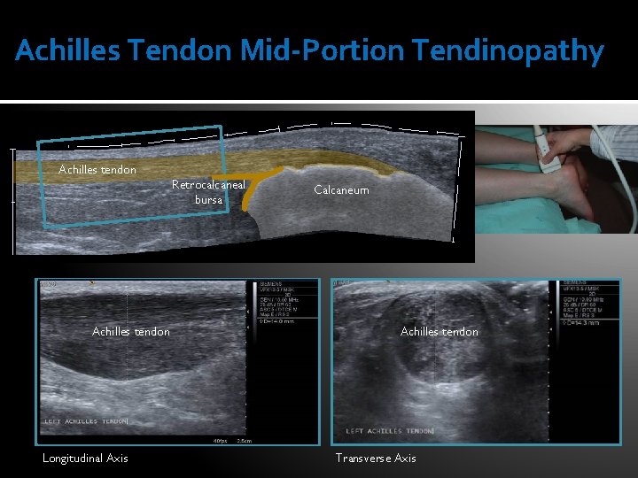 Achilles Tendon Mid-Portion Tendinopathy Achilles tendon Retrocalcaneal bursa Achilles tendon Longitudinal Axis Calcaneum Achilles