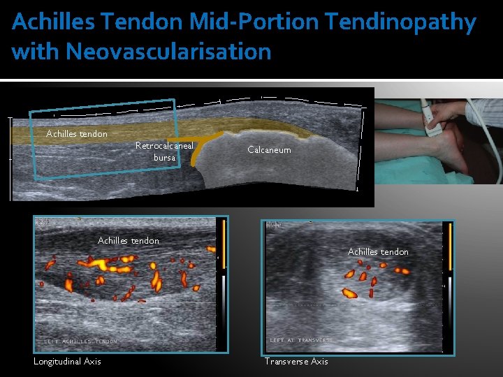 Achilles Tendon Mid-Portion Tendinopathy with Neovascularisation Achilles tendon Retrocalcaneal bursa Calcaneum Achilles tendon Longitudinal