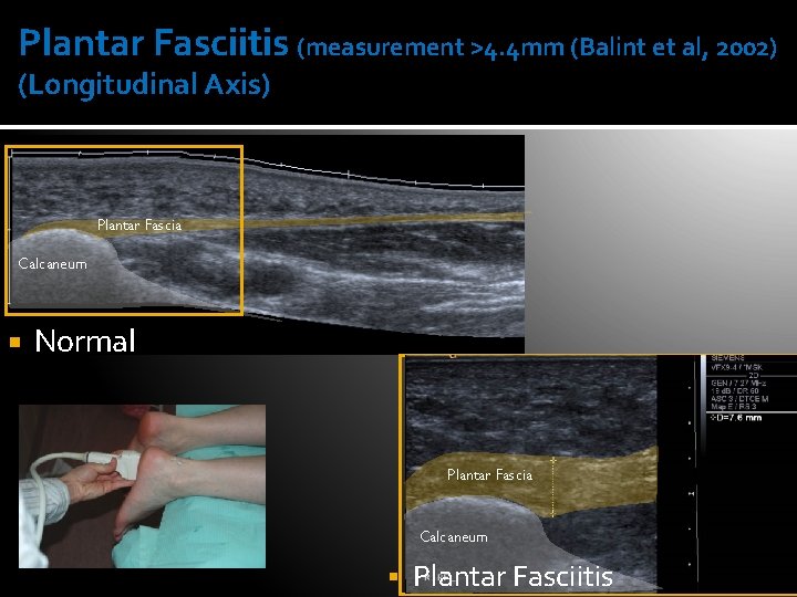 Plantar Fasciitis (measurement >4. 4 mm (Balint et al, 2002) (Longitudinal Axis) Plantar Fascia