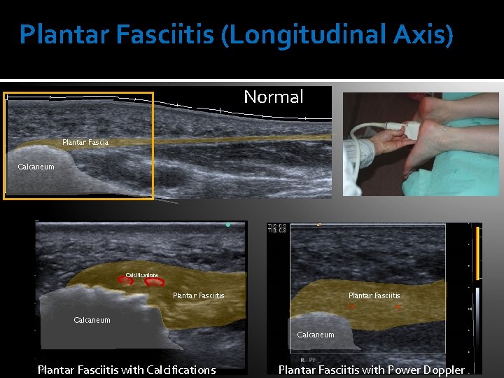 Plantar Fasciitis (Longitudinal Axis) Normal Plantar Fascia Calcaneum Calcifications Plantar Fasciitis Calcaneum Plantar Fasciitis
