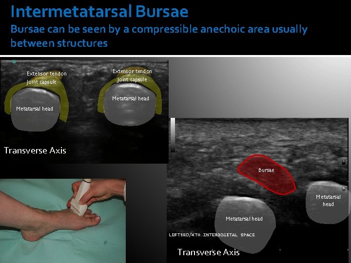 Intermetatarsal Bursae can be seen by a compressible anechoic area usually between structures Extensor