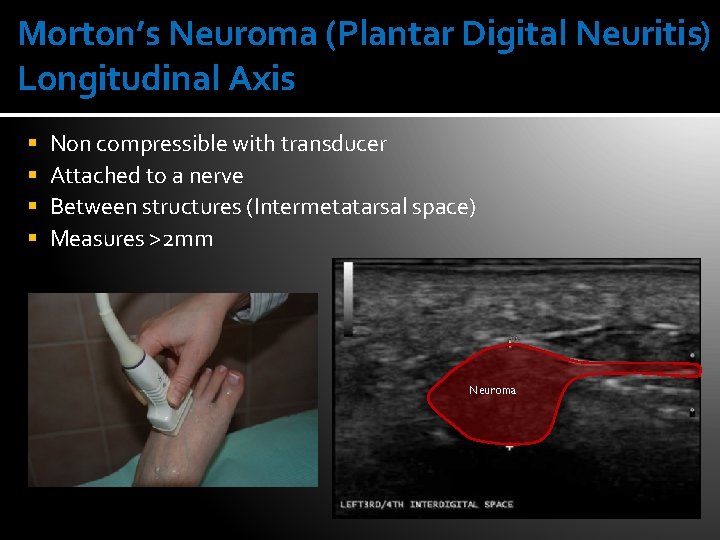 Morton’s Neuroma (Plantar Digital Neuritis) Longitudinal Axis § § Non compressible with transducer Attached