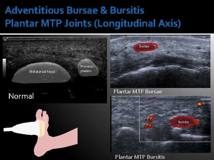 Adventitious Bursae & Bursitis Plantar MTP Joints (Longitudinal Axis) Bursae Metatarsal head Normal Proximal