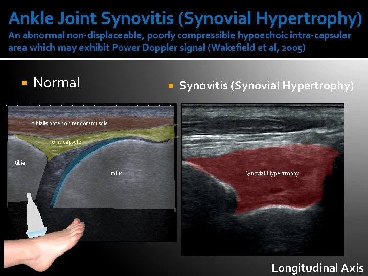 Ankle Joint Synovitis (Synovial Hypertrophy) An abnormal non-displaceable, poorly compressible hypoechoic intra-capsular area which