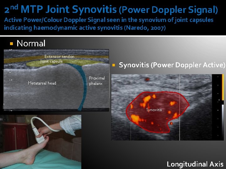 2 nd MTP Joint Synovitis (Power Doppler Signal) Active Power/Colour Doppler Signal seen in