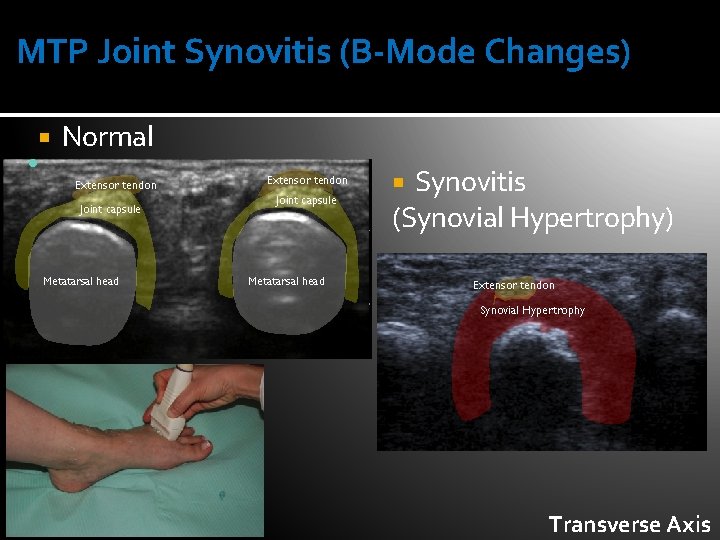 MTP Joint Synovitis (B-Mode Changes) Normal Extensor tendon Joint capsule Metatarsal head Synovitis (Synovial