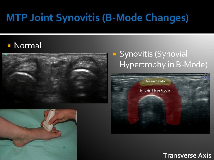 MTP Joint Synovitis (B-Mode Changes) Normal Synovitis (Synovial Hypertrophy in B-Mode) Extensor tendon Synovial
