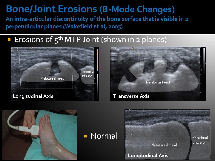 Bone/Joint Erosions (B-Mode Changes) An intra-articular discontinuity of the bone surface that is visible