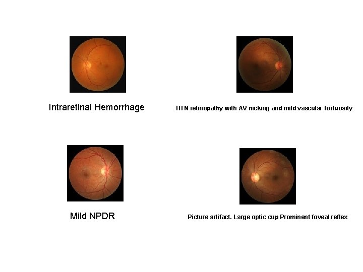 Intraretinal Hemorrhage Mild NPDR HTN retinopathy with AV nicking and mild vascular tortuosity Picture