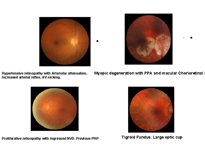  · • Hypertensive retinopathy with Arteriolar attenuation. Increased arterial reflex. AV nicking. ·