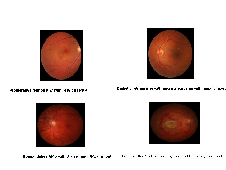 Proliferative retinopathy with previous PRP Nonexudative AMD with Drusen and RPE dropout Diabetic retinopathy