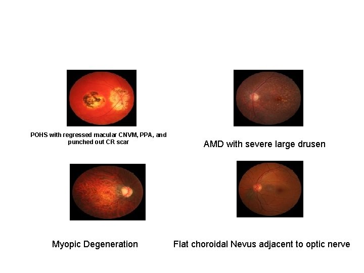 POHS with regressed macular CNVM, PPA, and punched out CR scar Myopic Degeneration AMD