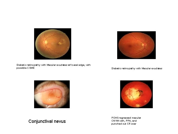 Diabetic retinopathy with Macular exudates at foveal edge, with possible CSME Conjunctival nevus Diabetic