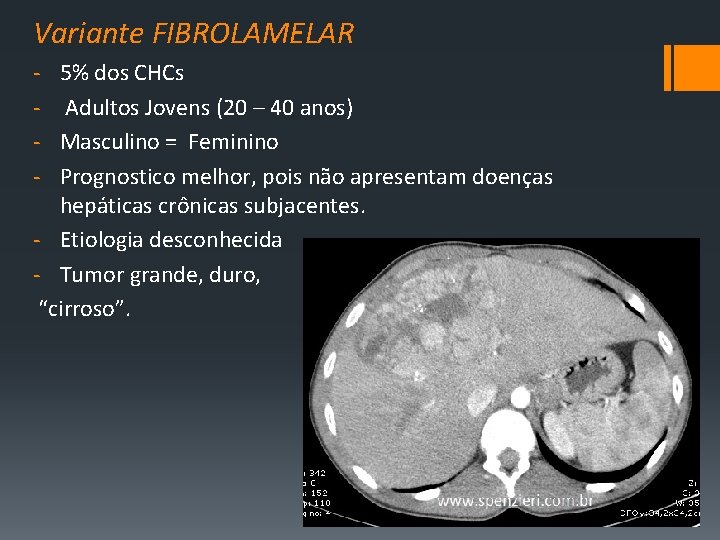 Variante FIBROLAMELAR ‐ ‐ 5% dos CHCs Adultos Jovens (20 – 40 anos) Masculino