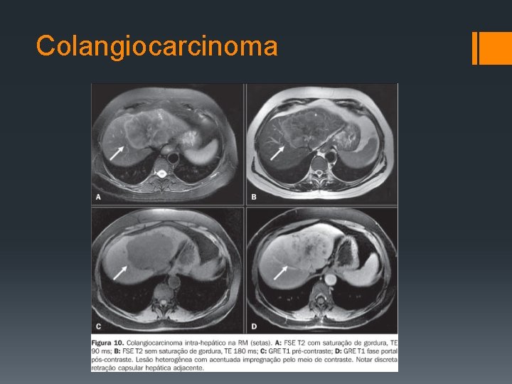 Colangiocarcinoma 