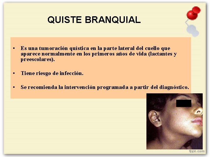 QUISTE BRANQUIAL • Es una tumoración quística en la parte lateral del cuello que