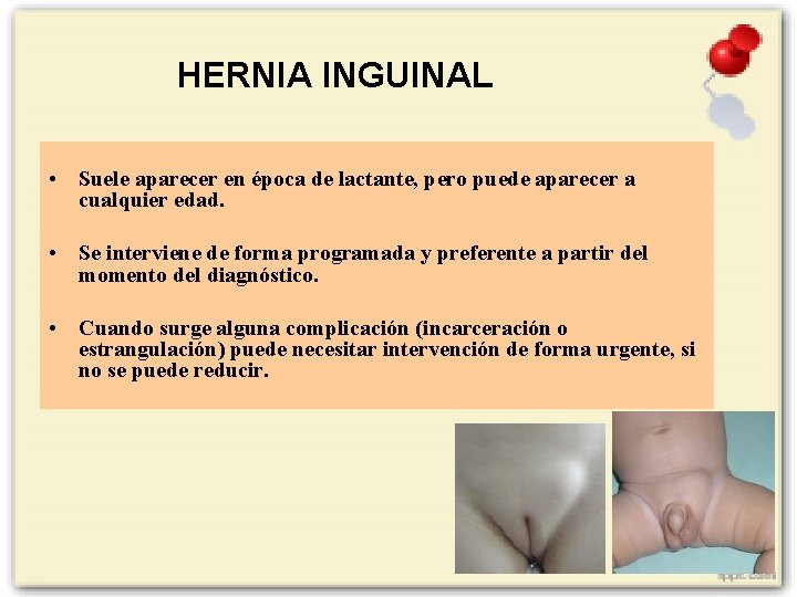 HERNIA INGUINAL • Suele aparecer en época de lactante, pero puede aparecer a cualquier