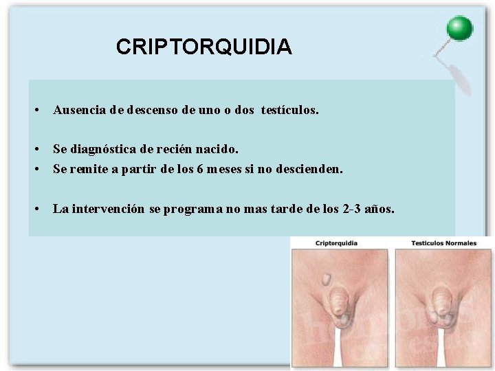 CRIPTORQUIDIA • Ausencia de descenso de uno o dos testículos. • Se diagnóstica de