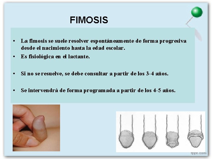 FIMOSIS • La fimosis se suele resolver espontáneamente de forma progresiva desde el nacimiento