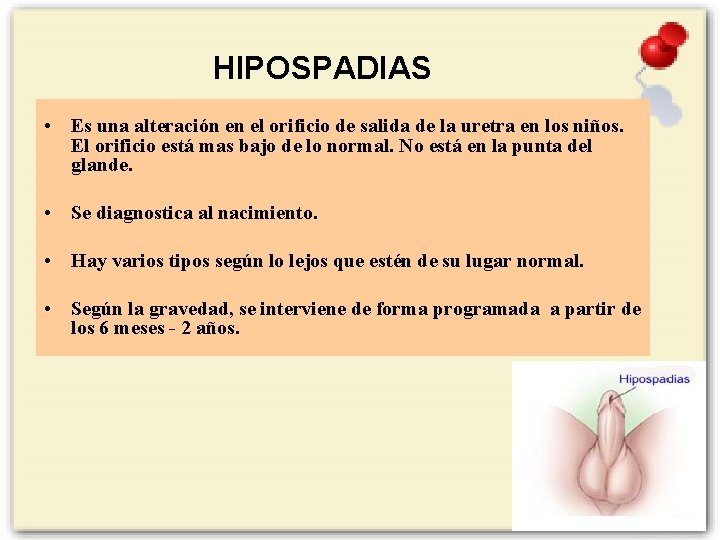 HIPOSPADIAS • Es una alteración en el orificio de salida de la uretra en