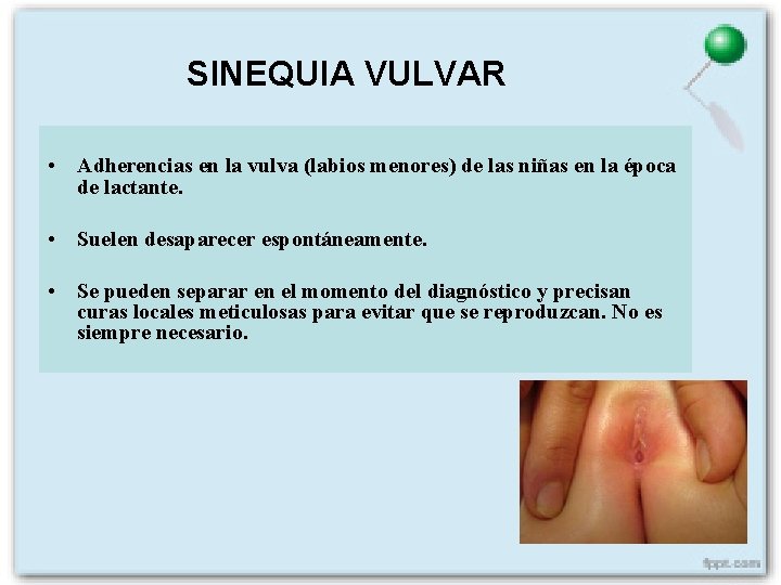 SINEQUIA VULVAR • Adherencias en la vulva (labios menores) de las niñas en la
