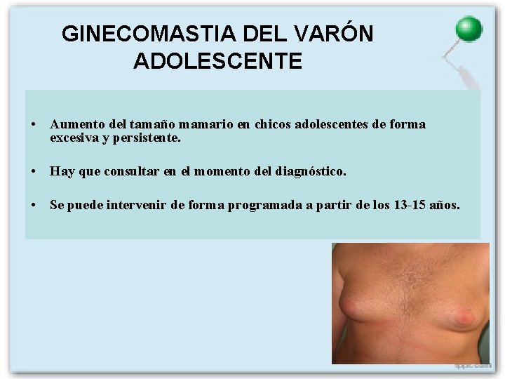 GINECOMASTIA DEL VARÓN ADOLESCENTE • Aumento del tamaño mamario en chicos adolescentes de forma