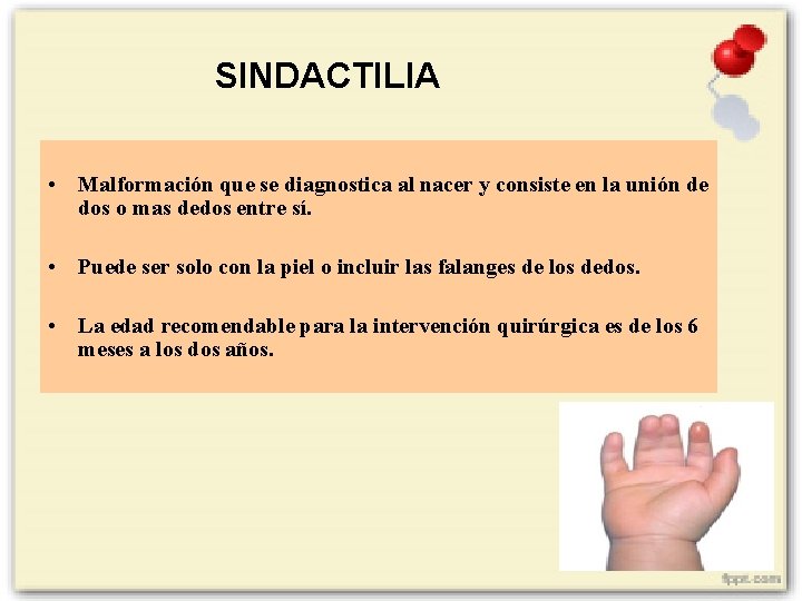 SINDACTILIA • Malformación que se diagnostica al nacer y consiste en la unión de